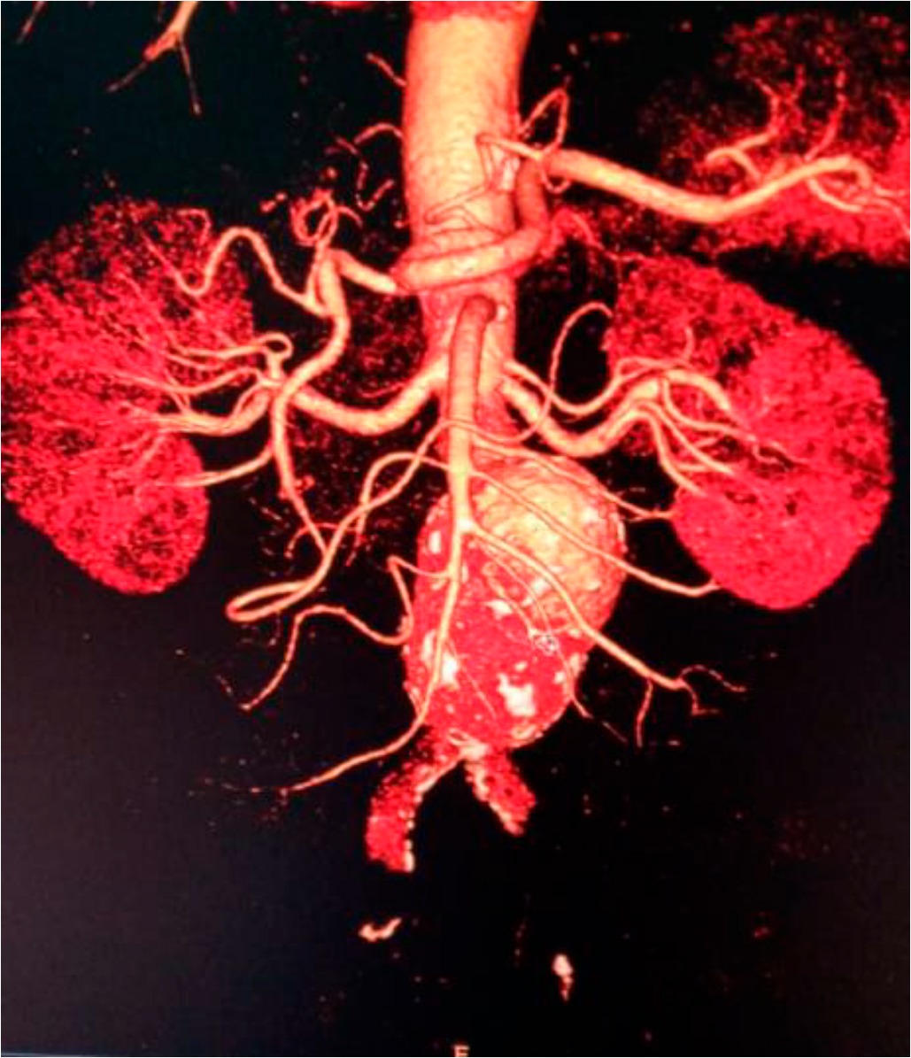 Aneurisma de aorta abdominal