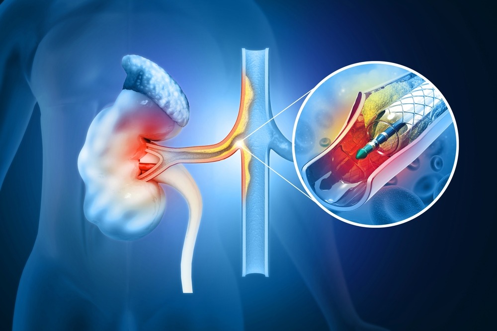 Stent,Angioplasty.,Renal,Artery,Disease.,Atherosclerosis,Progression,At,The,End