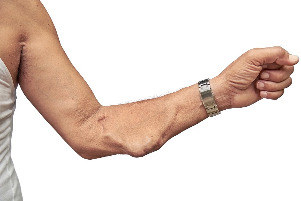 Clinical,Image,In,Nephrology,And,Dialysis:arteriovenous,Fistula,In,The,Right