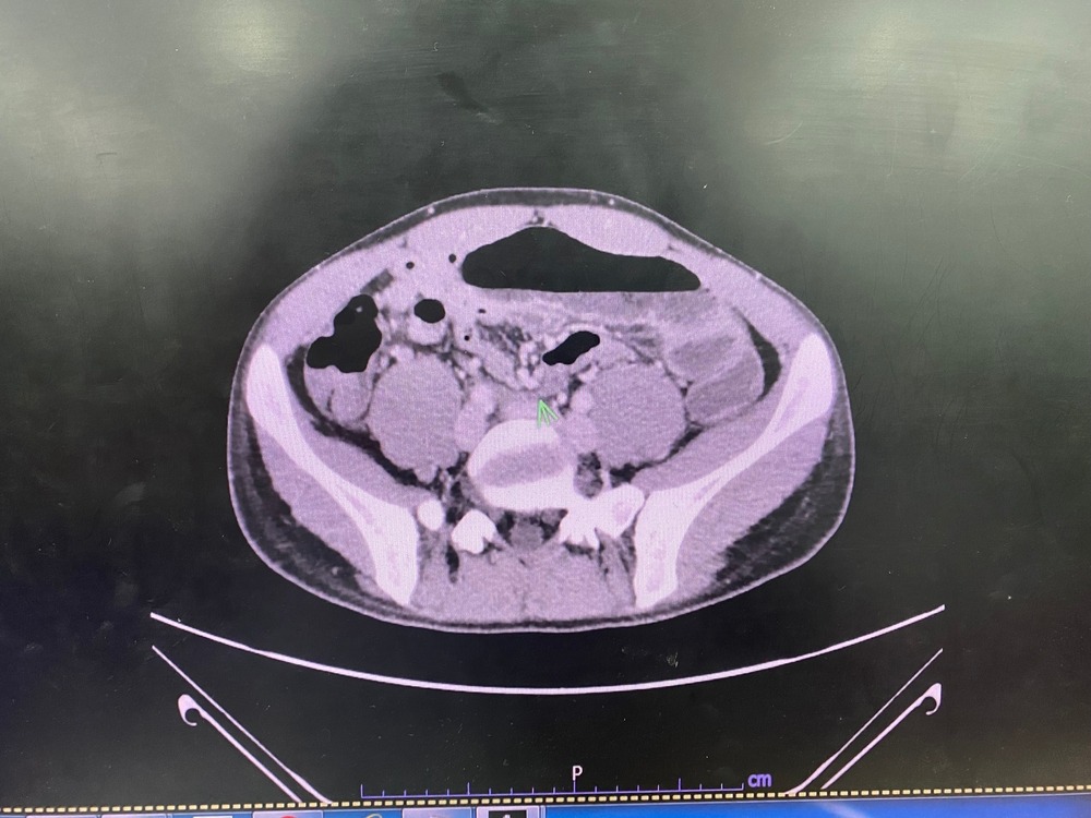 The,Picture,Of,Computed,Tomography,Scan,With,Contrast,Of,Patient
