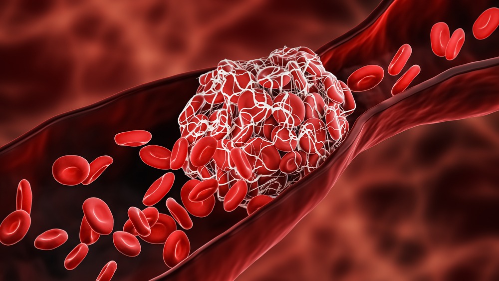 Blood,Clot,Or,Thrombus,Blocking,The,Red,Blood,Cells,Stream